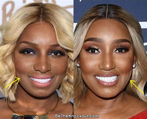 nene leaks before surgery|NeNe Leakes Plastic Surgery Before And After Photos